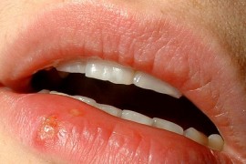 Šta uzrokuje herpes?