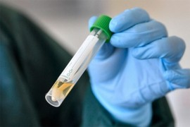 U Hrvatskoj povećan broj zaraženih virusom korona, troje u teškom ...