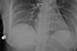 Ženi pogođenoj metkom implantant spasio život