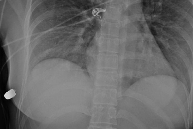 Ženi pogođenoj metkom implantant spasio život