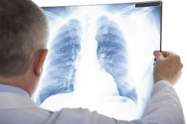 Sve manje oboljelih od tuberkuloze