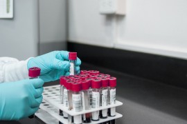 Jednostavan način da provjerite da li imate anemiju