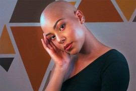 Šta je alopecija areata sa kojom se bori žena Vila Smita