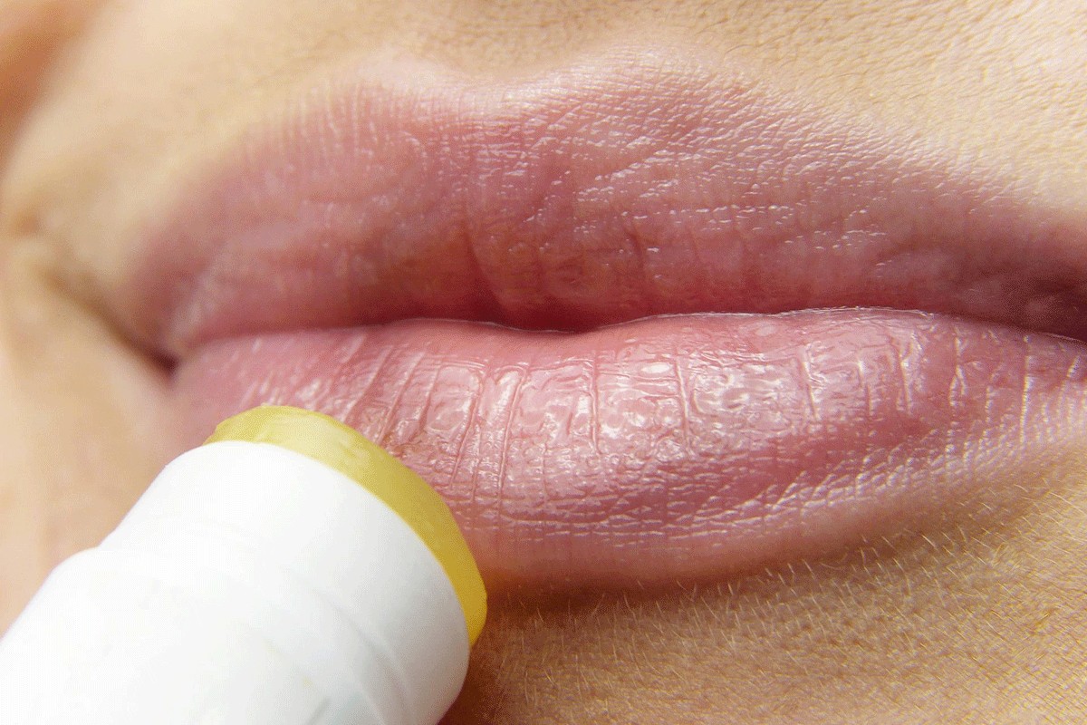 Naučnici otkrili: Zašto se herpes uvijek vraća?