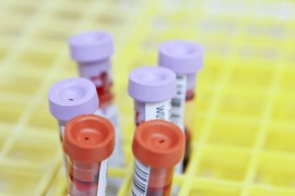FZO RS: Testiranje na nasljedni tumor dojke moguće u Srbiji