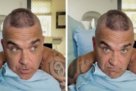 Robi Vilijams: Moraću prihvatiti da gubim kosu, od tableta sam ...