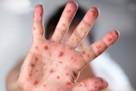 U Srbiji potvrđeni prvi slučajevi malih boginja