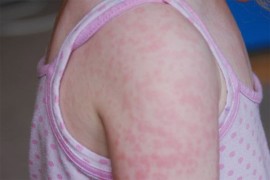 Crna Gora na pragu epidemije morbilama