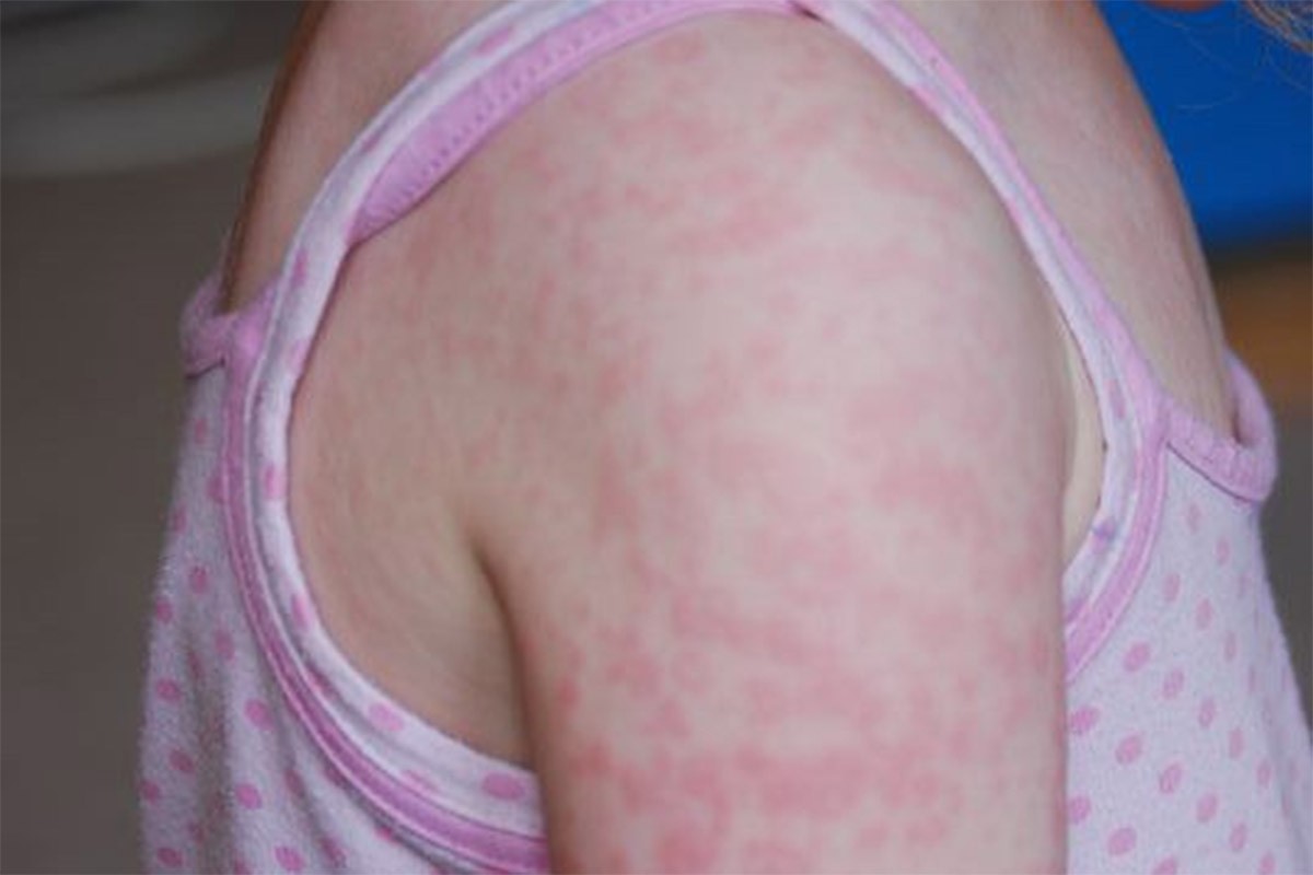 Crna Gora na pragu epidemije morbilama