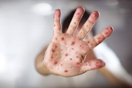 Institut: Nije isključena mogućnost epidemije morbila u Srpskoj