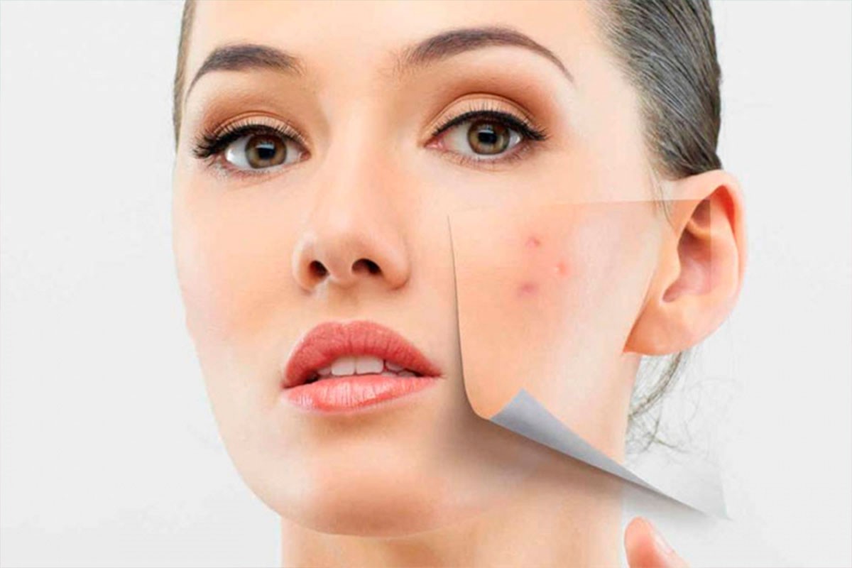 Besplatni dermatovenerološki pregledi akni širom BiH