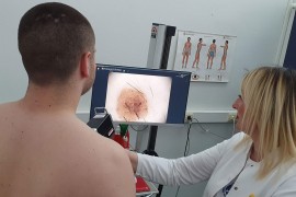Kampanja "Euromelanoma 2023": Sumnja na melanom kože kod dvije osobe