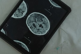 Maskova kompanija će ove godine izvršiti prvu implantaciju moždanog ...