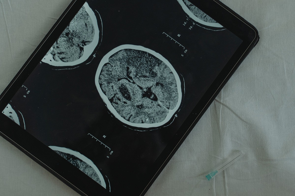 Maskova kompanija će ove godine izvršiti prvu implantaciju moždanog čipa