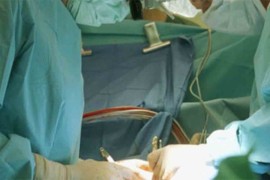 Prva transplantacija bubrega na dečijoj klinici u Beogradu