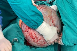 Detalji operacije u Banjaluci: Tumor težak 23 kilograma uklanjali dva ...