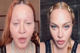 Otkriven pravi razlog Madoninog natečenog lica?