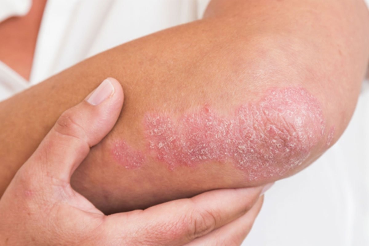 Ovi simptomi ukazuju na psorijazu kod djece