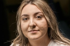 Problem za mnoge: Šta uzrokuje akne u odrasloj dobi?