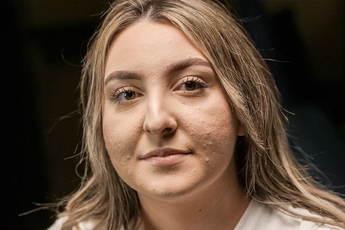 Problem za mnoge: Šta uzrokuje akne u odrasloj dobi?