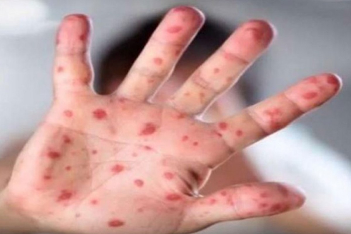 U Kantonu Sarajevo proglašena epidemija morbila