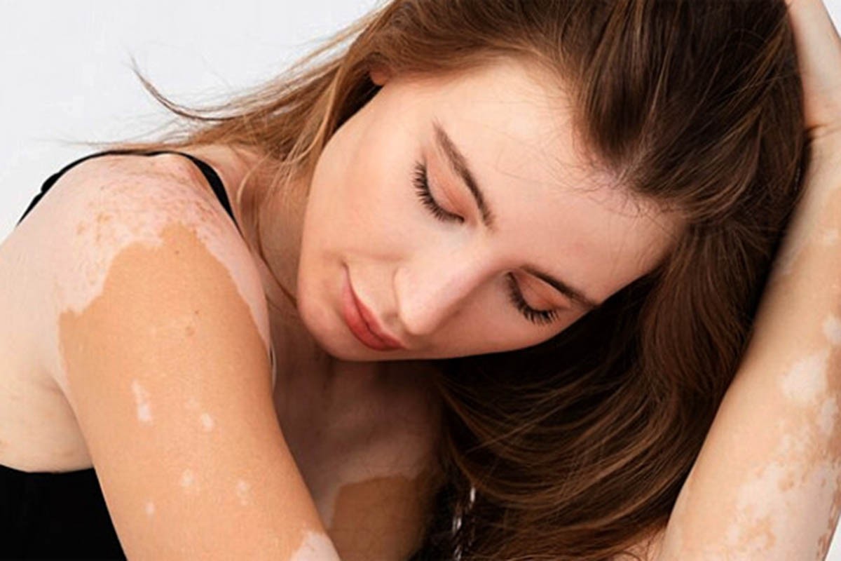 Vitiligo traži trpezu bogatu ovim vitaminom