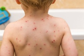 U Srpskoj 159 osoba zaraženo od morbila