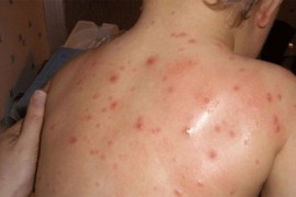 U Budvi proglašena epidemija morbila