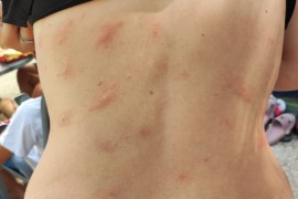 Slovenci u kampu u Hrvatskoj dobili osip (FOTO)