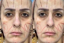 Slike prije i poslije plastične operacije: “Mora da vadi nova ...