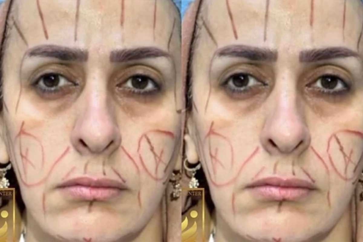 Slike prije i poslije plastične operacije: “Mora da vadi nova dokumenta” (FOTO)