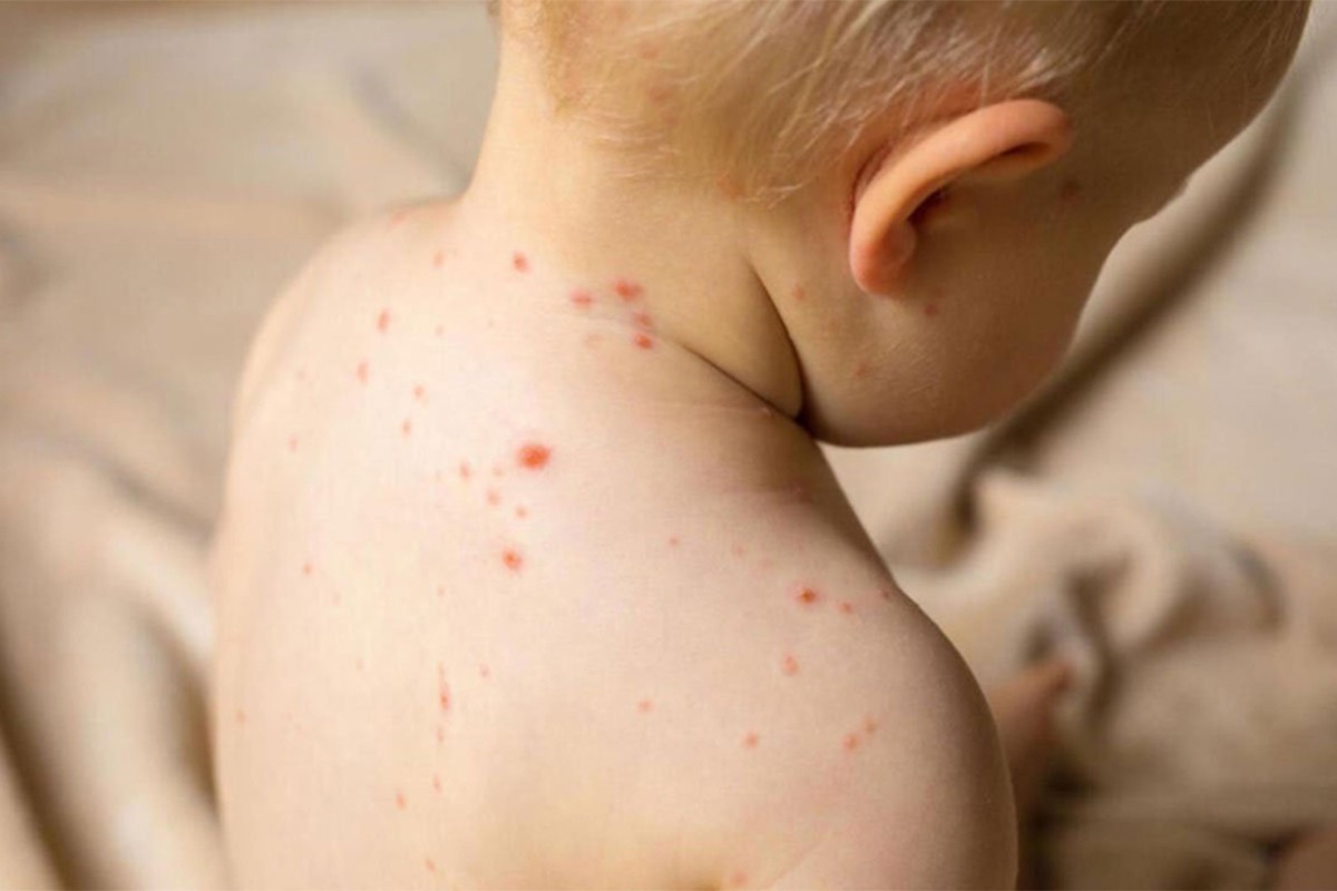Epidemija morbila proglašena u Podgorici i Budvi