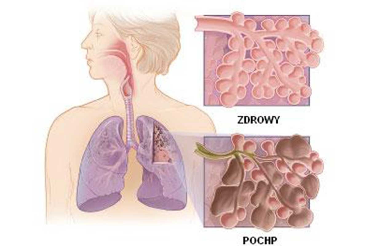 Šta je HOBP, bolest koju ima Bora Đorđević