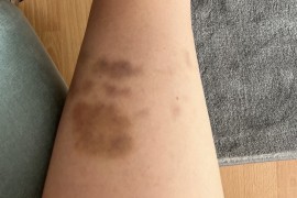 Ako stalno dobijate modrice: Kada je vrijeme za paniku