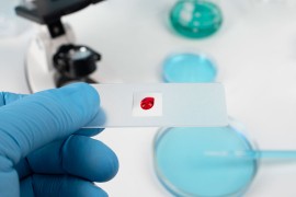 U Srpskoj 16 novih slučajeva oboljelih od HIV/AIDS-a, najviše ...