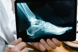 Ovako izgleda napad gihta: Doktor objašnjava kako se liječi to bolno ...