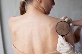 Besplatni preventivni pregledi kože u UKC RS