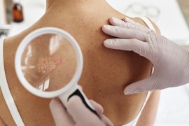 Psorijaza je više od kože