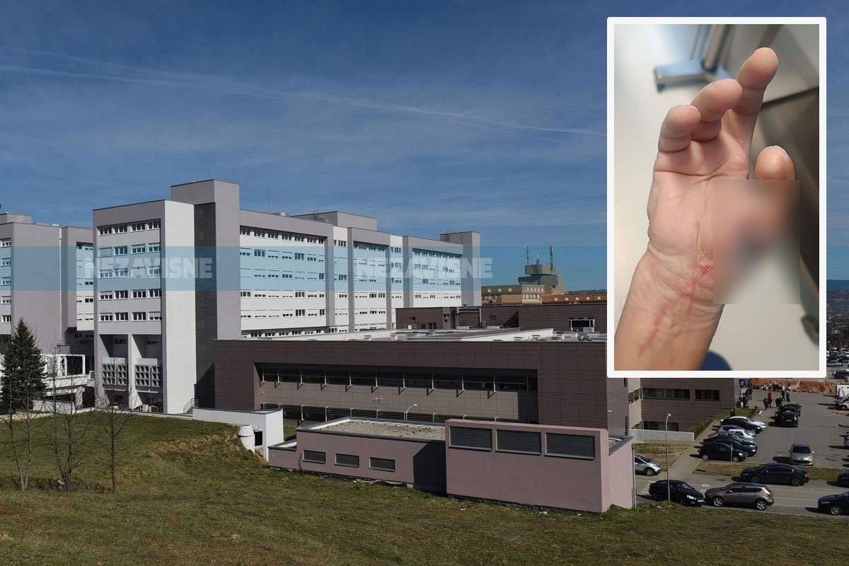 Kompleksan zahvat u UKC RS: Muškarcu presadili nožni prst na ruku