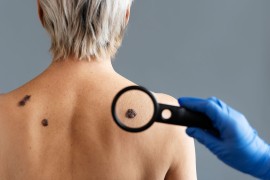 Maj u znaku borbe protiv melanoma, besplatni pregledi u UKC RS 29. maja