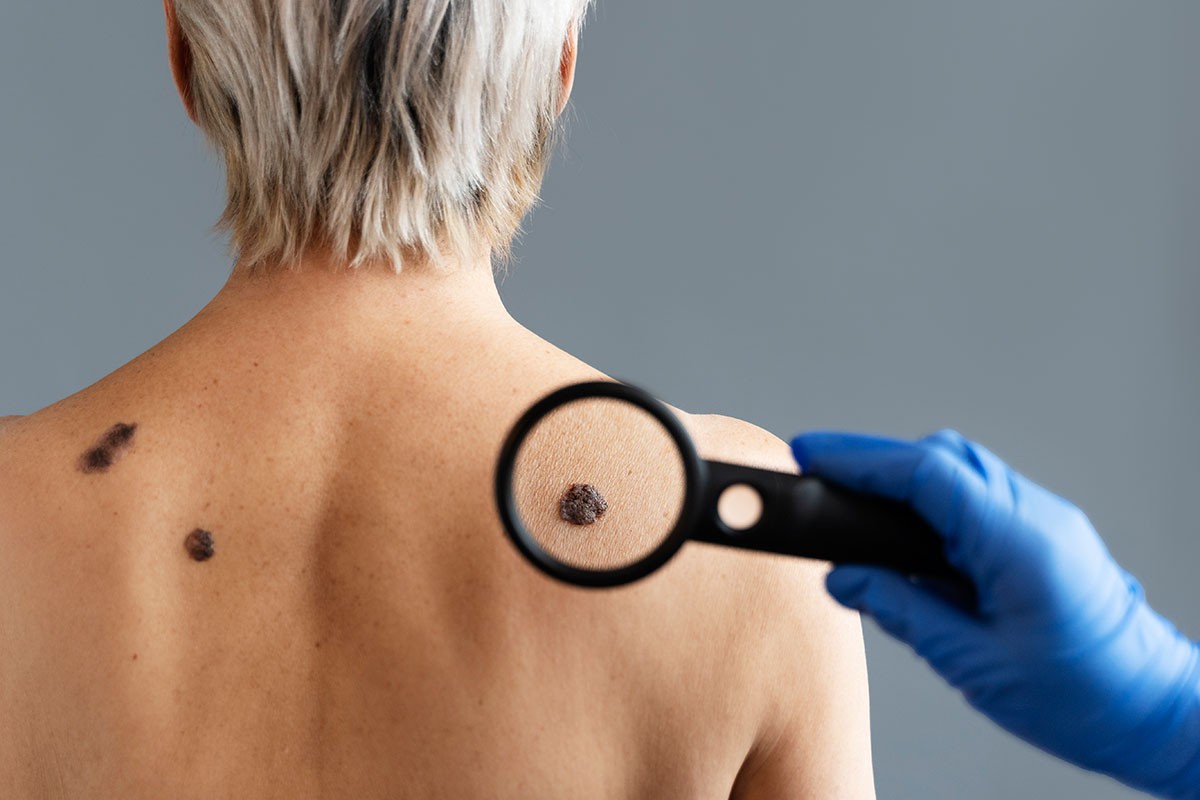Maj u znaku borbe protiv melanoma, besplatni pregledi u UKC RS 29. maja