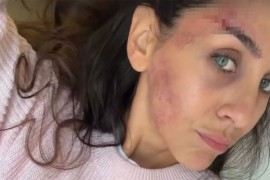 Ivana Dudić pokazala modrice na licu, pa otkrila šta joj se dogodilo