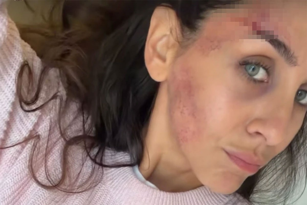 Ivana Dudić pokazala modrice na licu, pa otkrila šta joj se dogodilo
